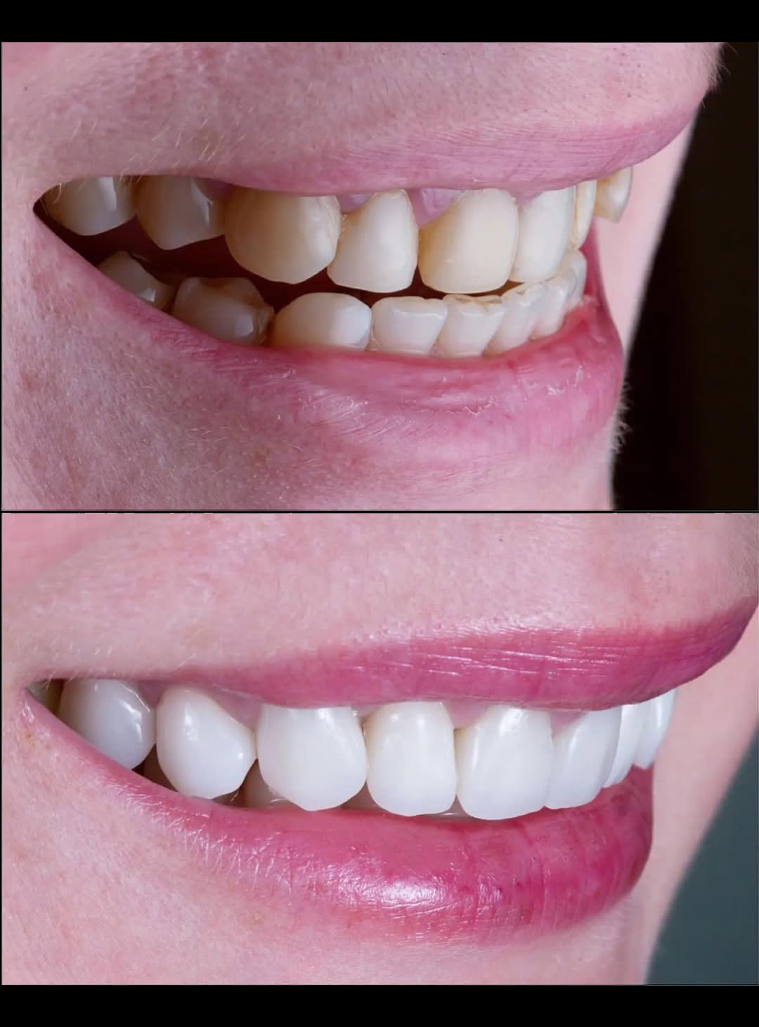 عکس قبل و بعد کامپوزیت ونیر برای طراحی لبخند زیبا