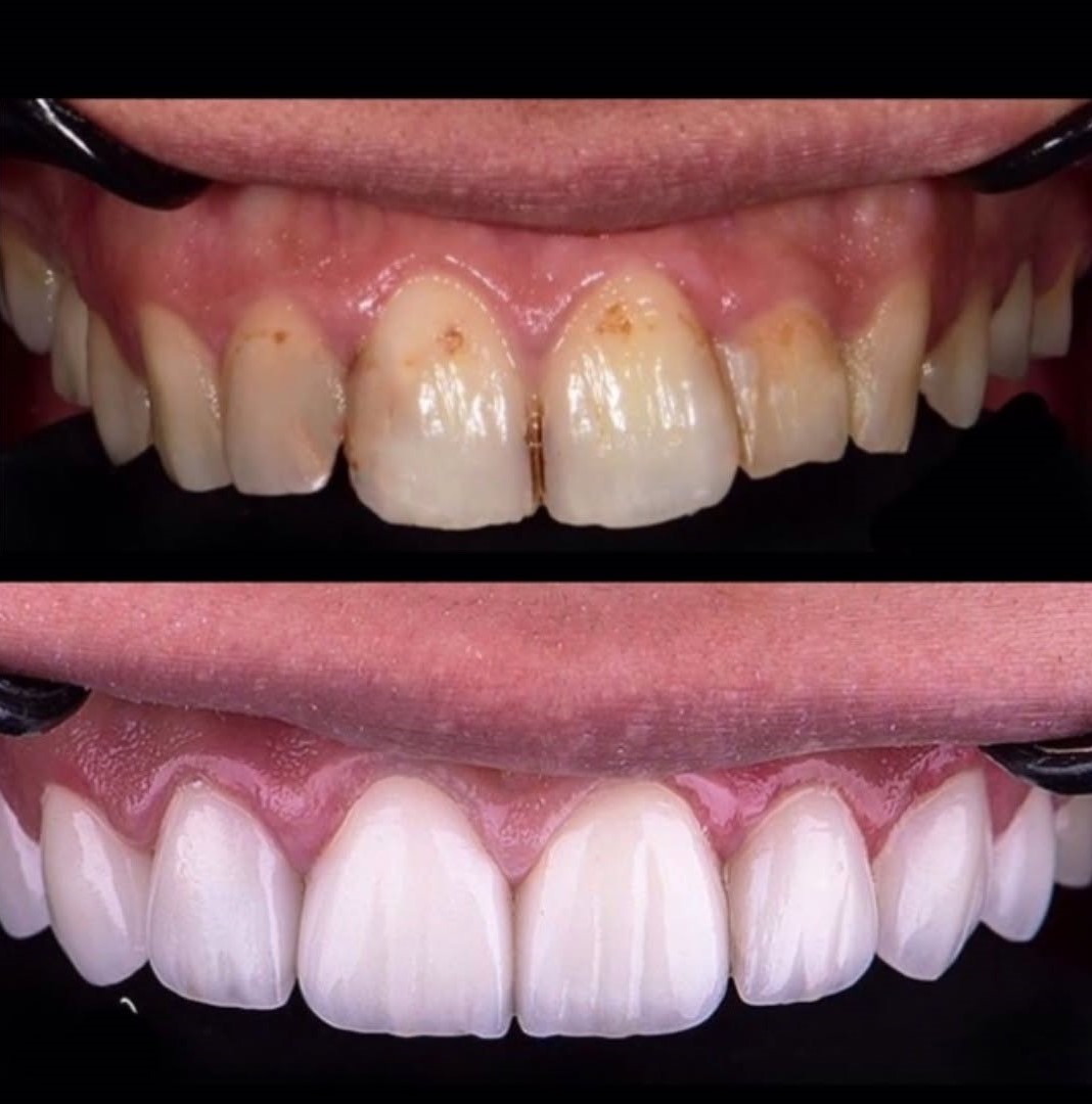 نمونه کار قبل و بعد ایمپلنت دندان شماره سه