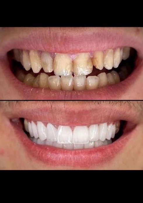 نمونه کار قبل و بعد ایمپلنت دندان شماره یک