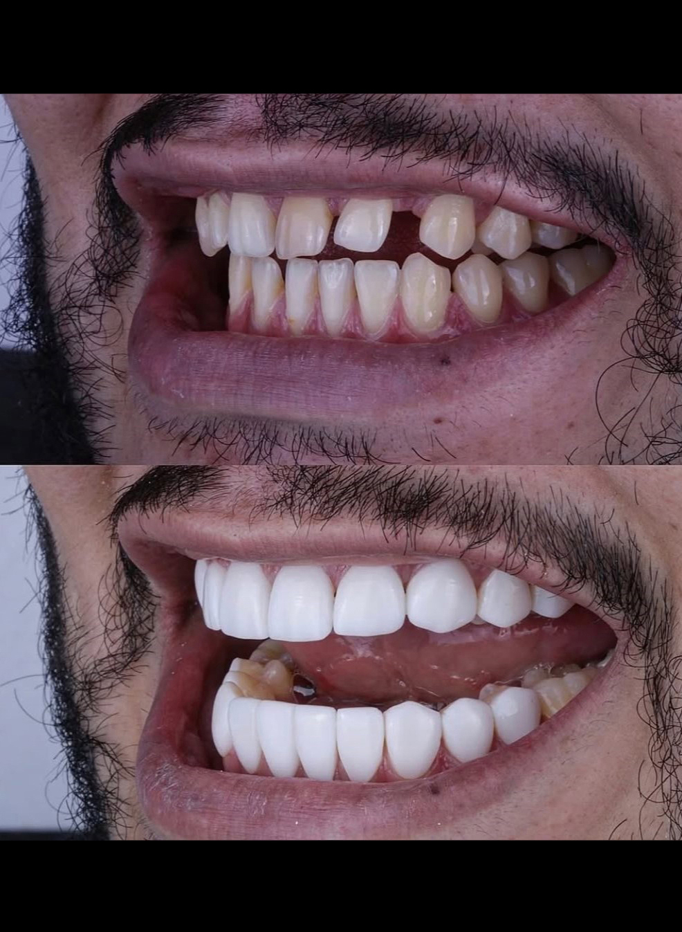 نمونه کار قبل و بعد ایمپلنت دندان شماره دو