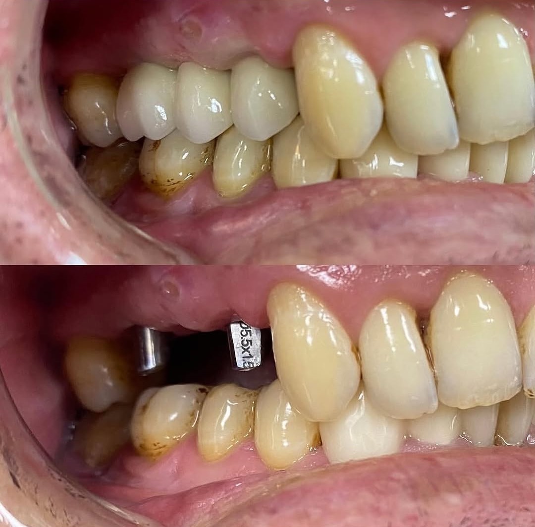 عکس قبل و بعد ایمپلنت دندان شماره دو