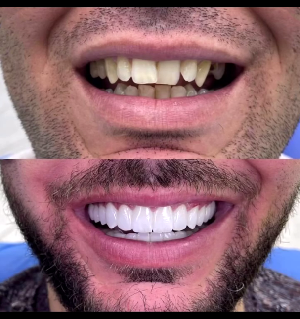 نمونه کار قبل و بعد لمینت سرامیکی دندان‌های جلو