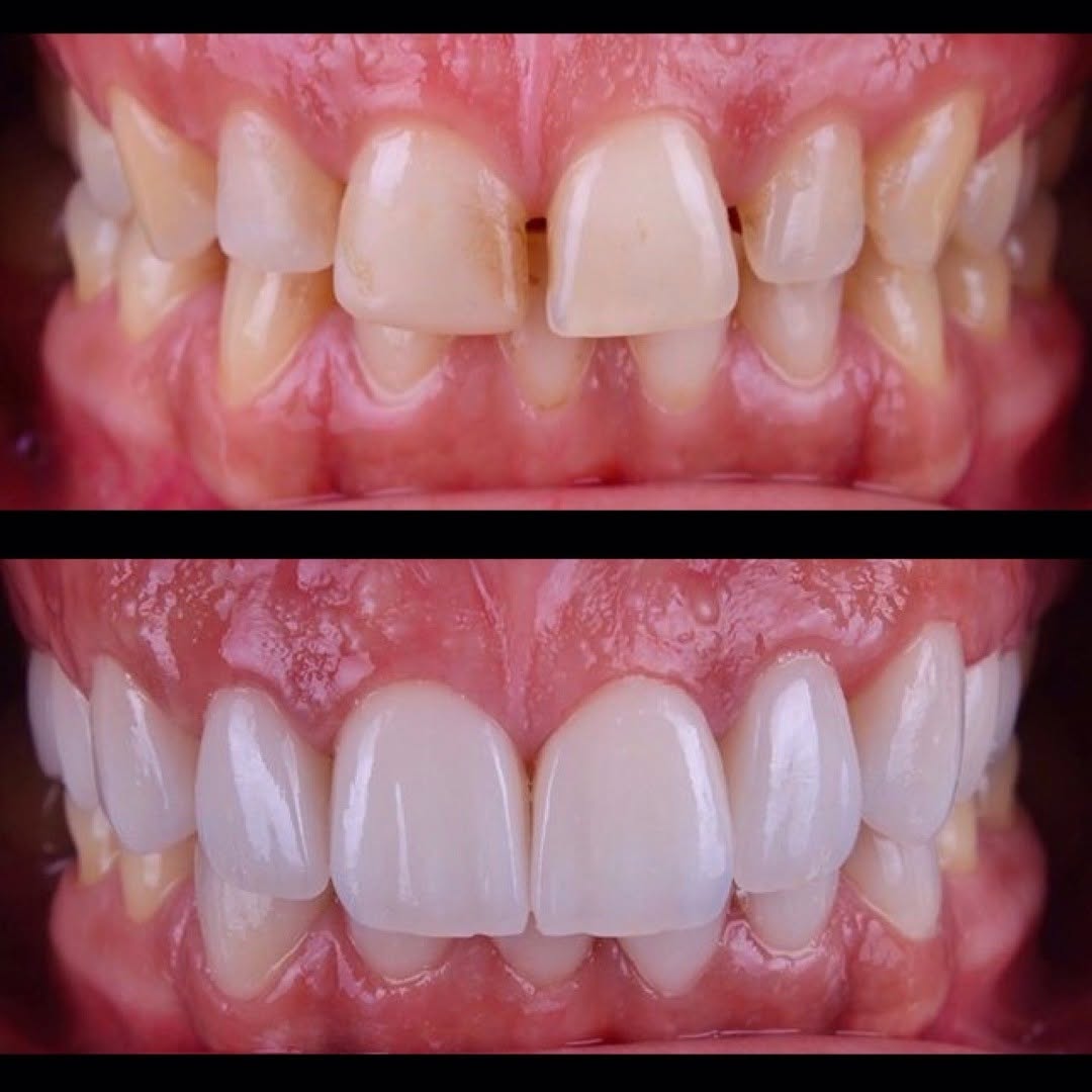 نمونه کار لمینت سرامیکی دندان‌های جلو